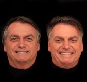 Leia mais sobre o artigo Bolsonaro faz harmonização facial de R$ 84 mil; veja antes e depois